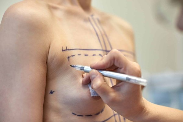 Tout savoir sur l'augmentation mammaire et ses techniques